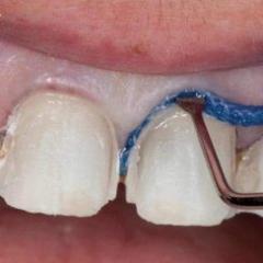 Ретракционная нить в стоматологии Ретракционной нити