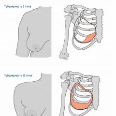 Тубулярная грудь - врожденное аномальное развитие молочных желез: способы коррекции