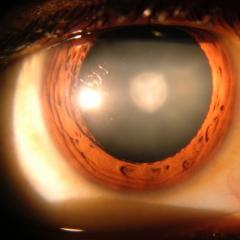 Перечень анализов для операции по удалению катаракты