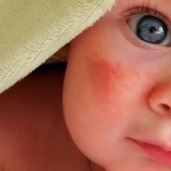Учимся справляться с диатезом на лице и щеках у ребенка: основные правила лечения Диатез шелушение как лечить