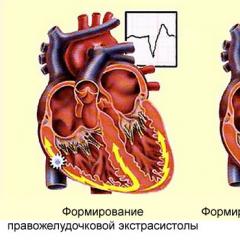Что такое экстрасистолия сердца, ее лечение и виды Болезнь сердца экстрасистолия