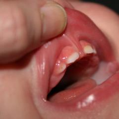 Short frenulum of the tongue in children - how to recognize and when to trim?